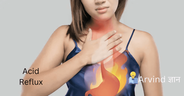 Home Remedies For Acid Reflux