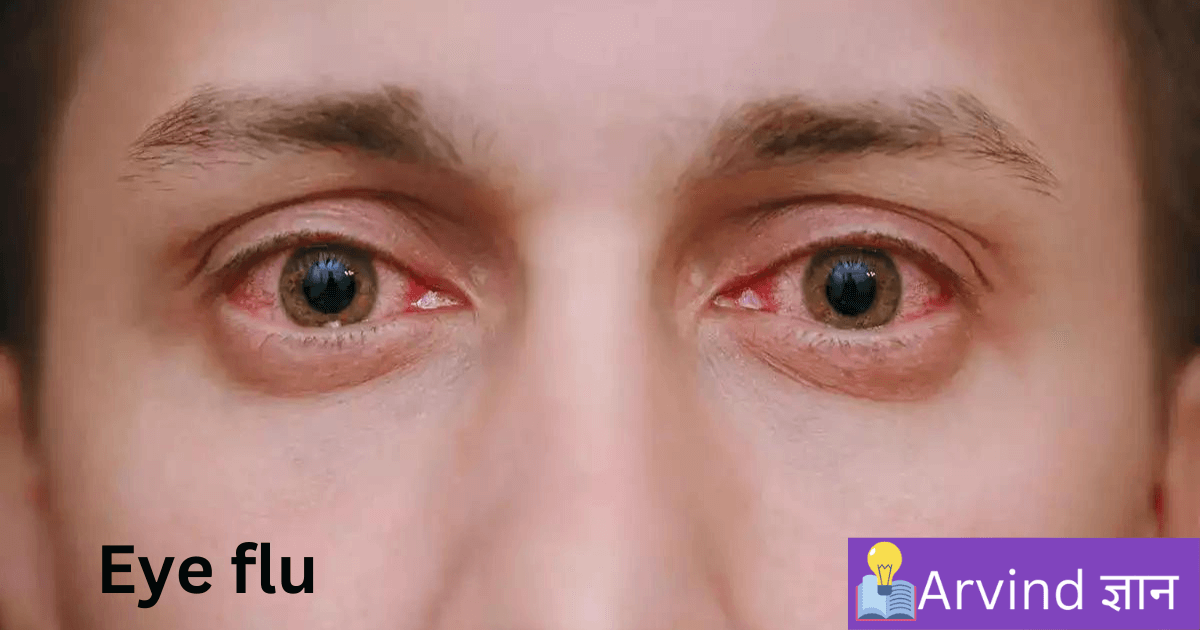 Eye Flu Treatment At Home